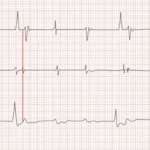 What is the normal range for an electrocardiogram (ECG)